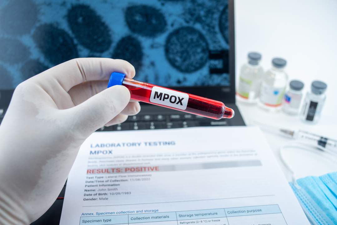 News24 | Namibia's health ministry declares outbreak of Mpox in Swakopmund