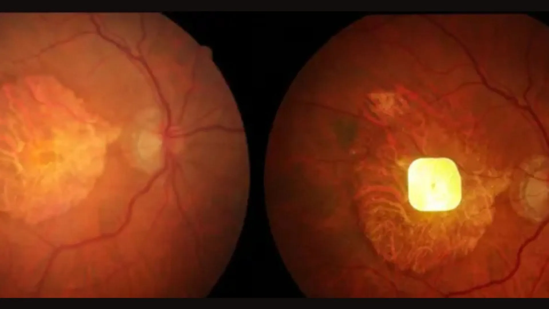 powered eye implant restores reading vision in blind patients