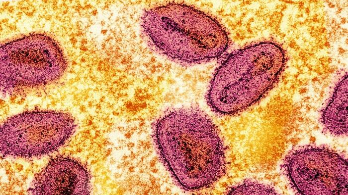 Severe Mpox Virus Strain Possibly Spreading In LA County, Officials Warn