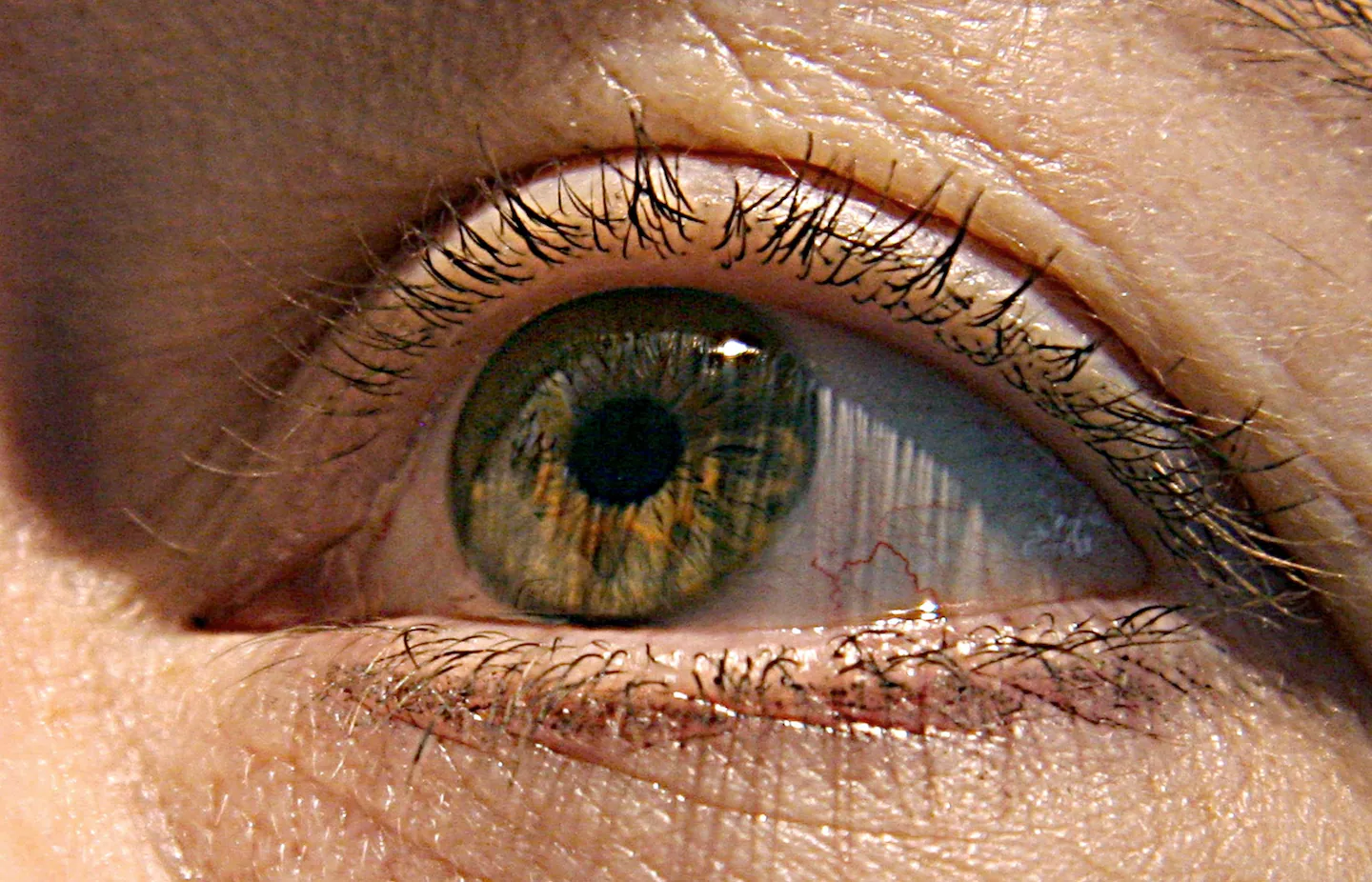 Vision restored using prosthetic retinal implant