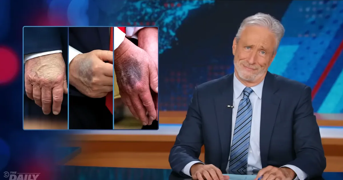 Jon Stewart Reveals What Donald Trump’s Bruised Hands Really Say About Him