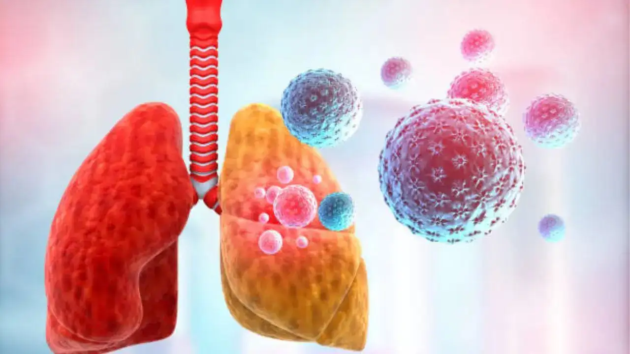 Pneumonia Alert: Early Warning Signs and Symptoms You Should Not Ignore