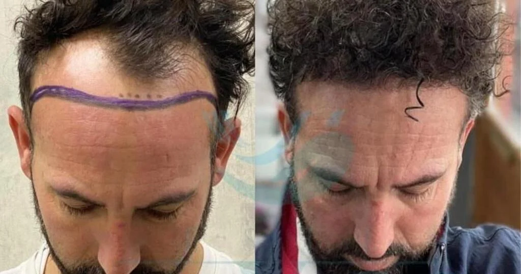 Top 10 Best Hair Transplant Clinics In Turkey: An Analysis Of Expertise, Newest Techniques, and All-Inclusive Packages