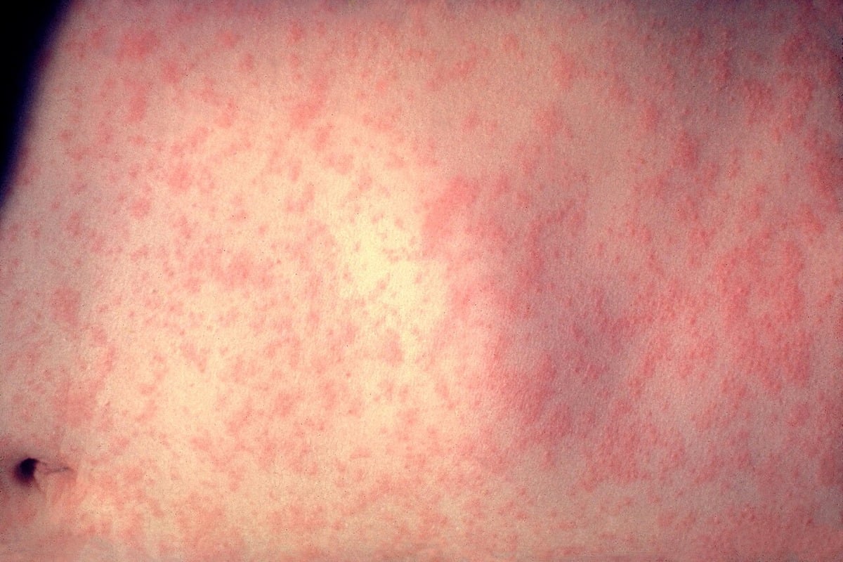 DOH Monitoring Measles in Kauaʻi Wastewater, Urges Vaccination