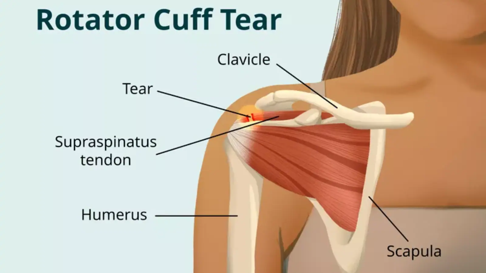 Are We Overlooking Simple Shoulder Injuries That Could Lead To Bigger Problems?