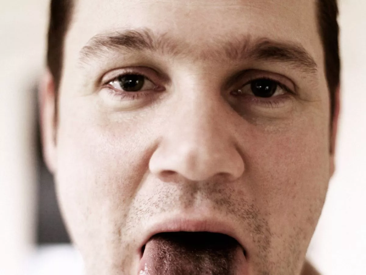 Dentist sheds light on condition turning tongues black and hairy
