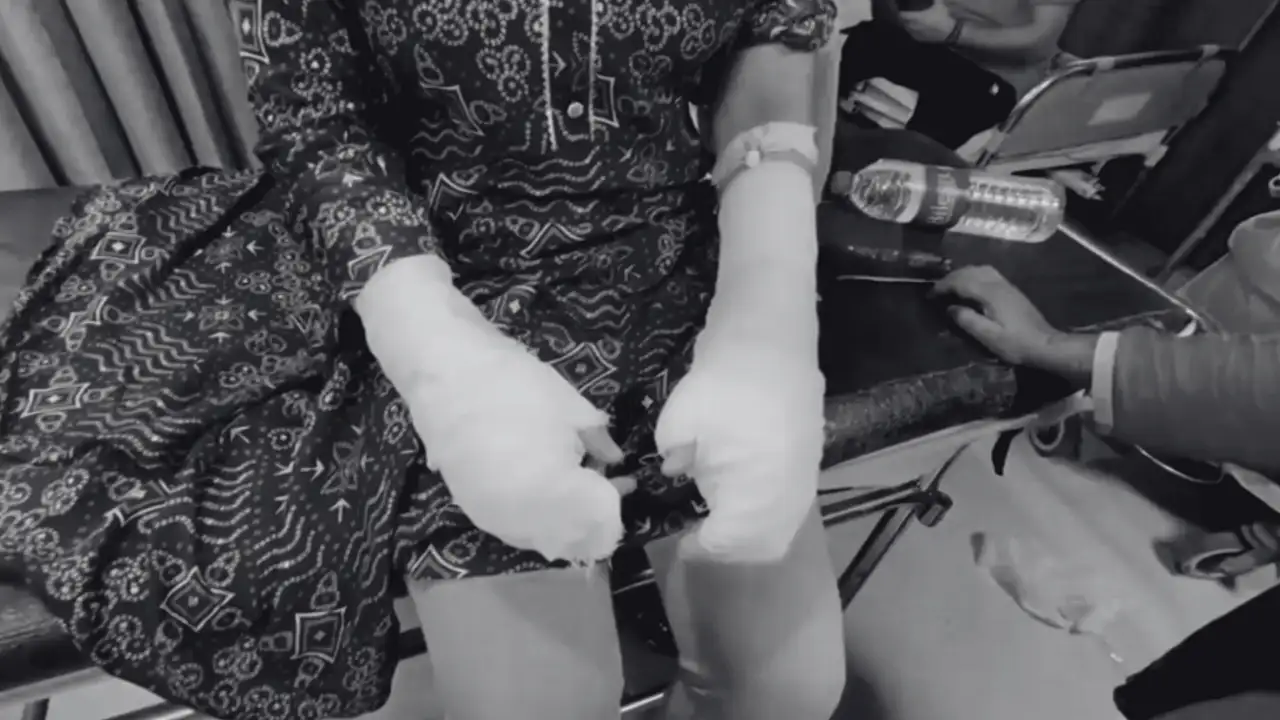 My Phone Melted: Delhi University Student Recounts Horror of Acid Attack by Stalker And His Friends