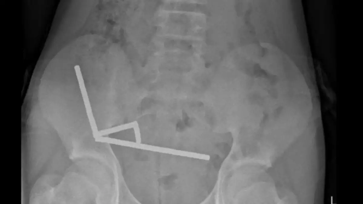 13-year-old boy forced to have part of his bowels removed after swallowing up to 100 magnets