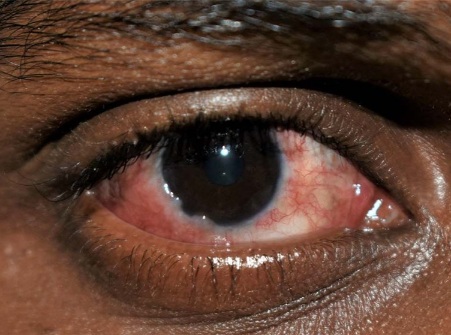 Don’t use breast milk for eye treatment –Optometrist advises