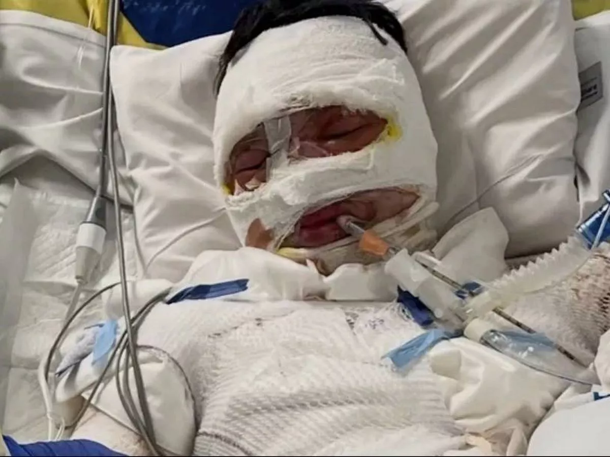 Teen 'doused in petrol and set alight' in horror attack as family reveal gruesome extent of injuries