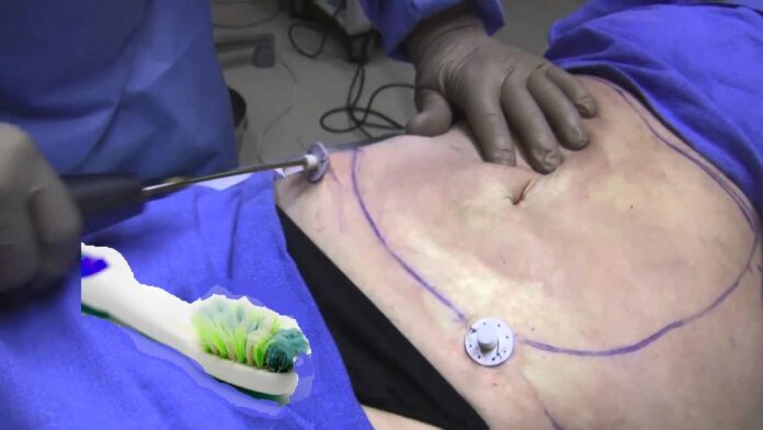 Toothbrush removed from man’s stomach