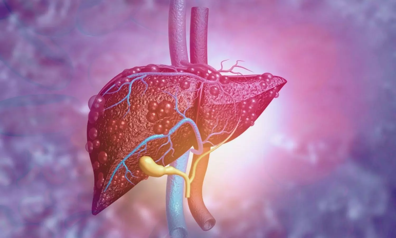 Lean MASLD Patients Face Higher Liver-Related Risks, Long-Term Study Finds