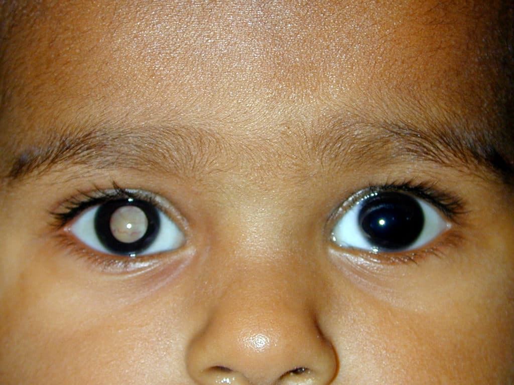 Joy Cancer Awareness Month: What you should know about retinoblastoma in children