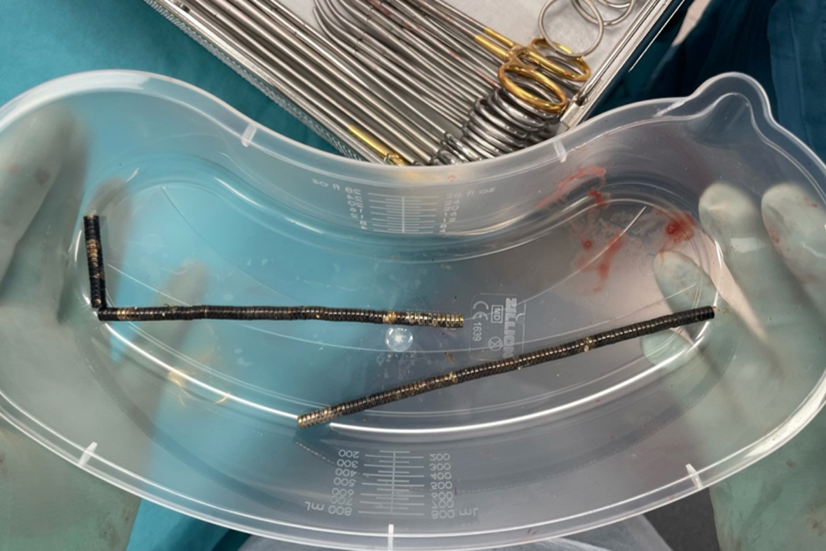 Surgeons remove up to 100 magnets from New Zealand teen’s gut