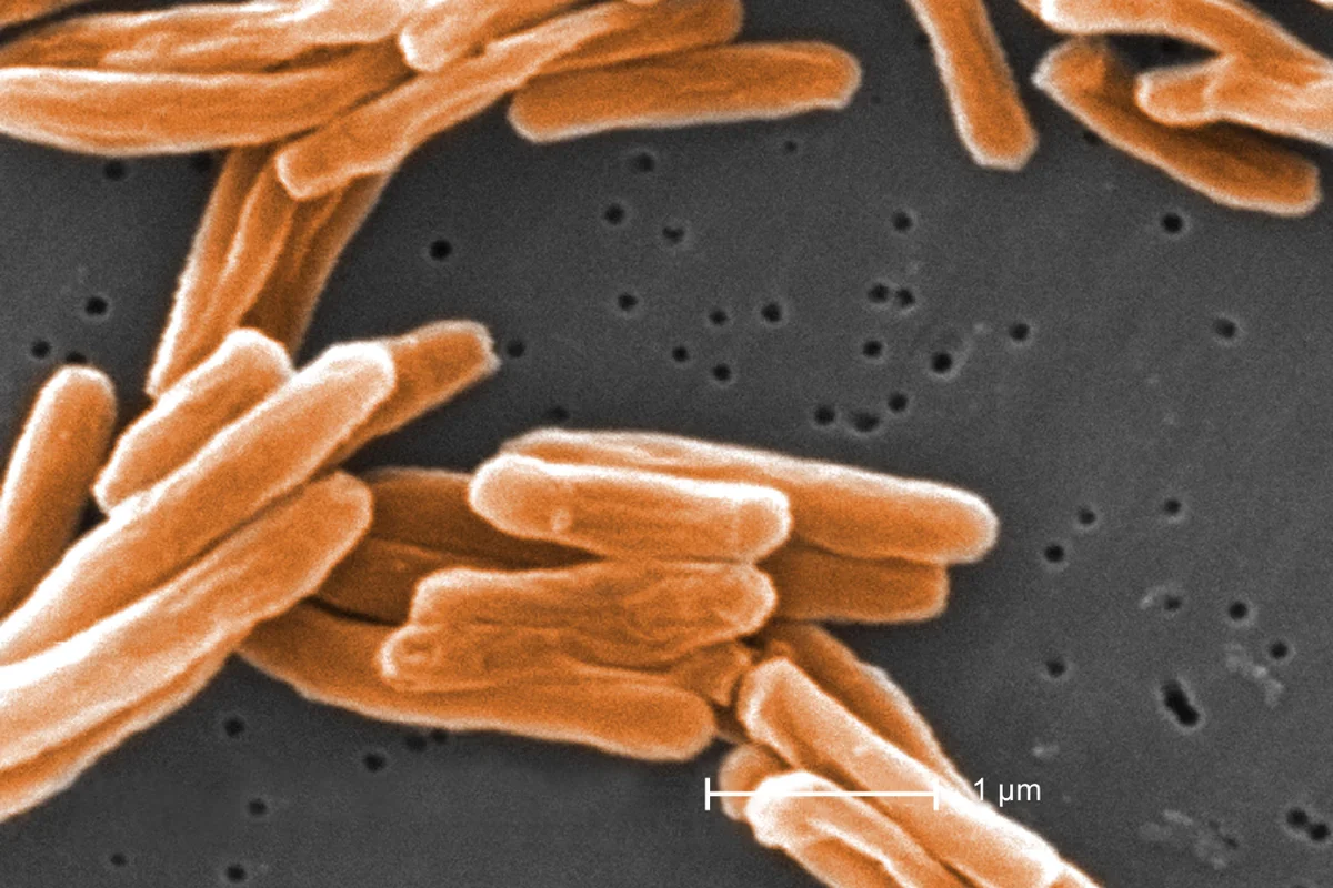 Tuberculosis cases are surging in the UK: Symptoms and advice you need to know