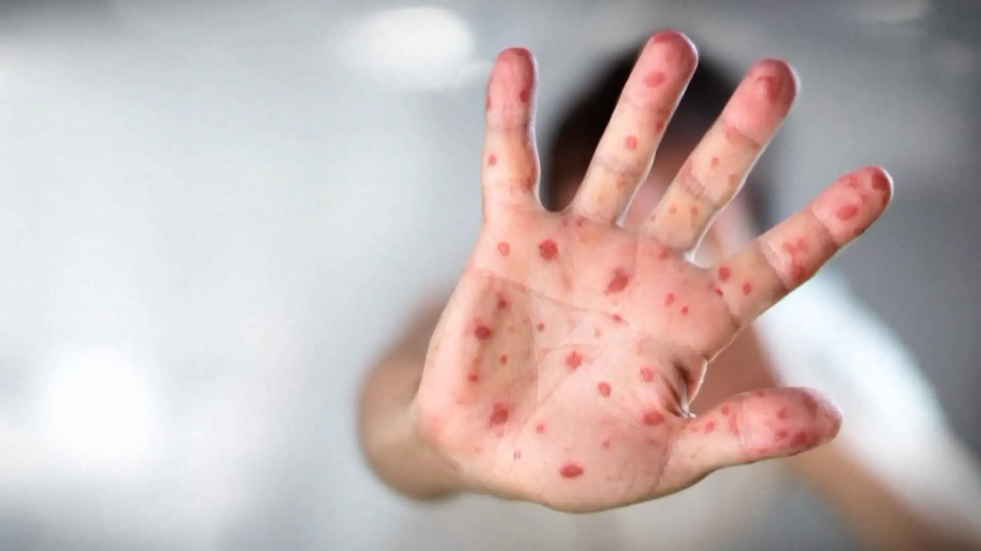 Canada could lose its status as a measles-free country amid outbreak