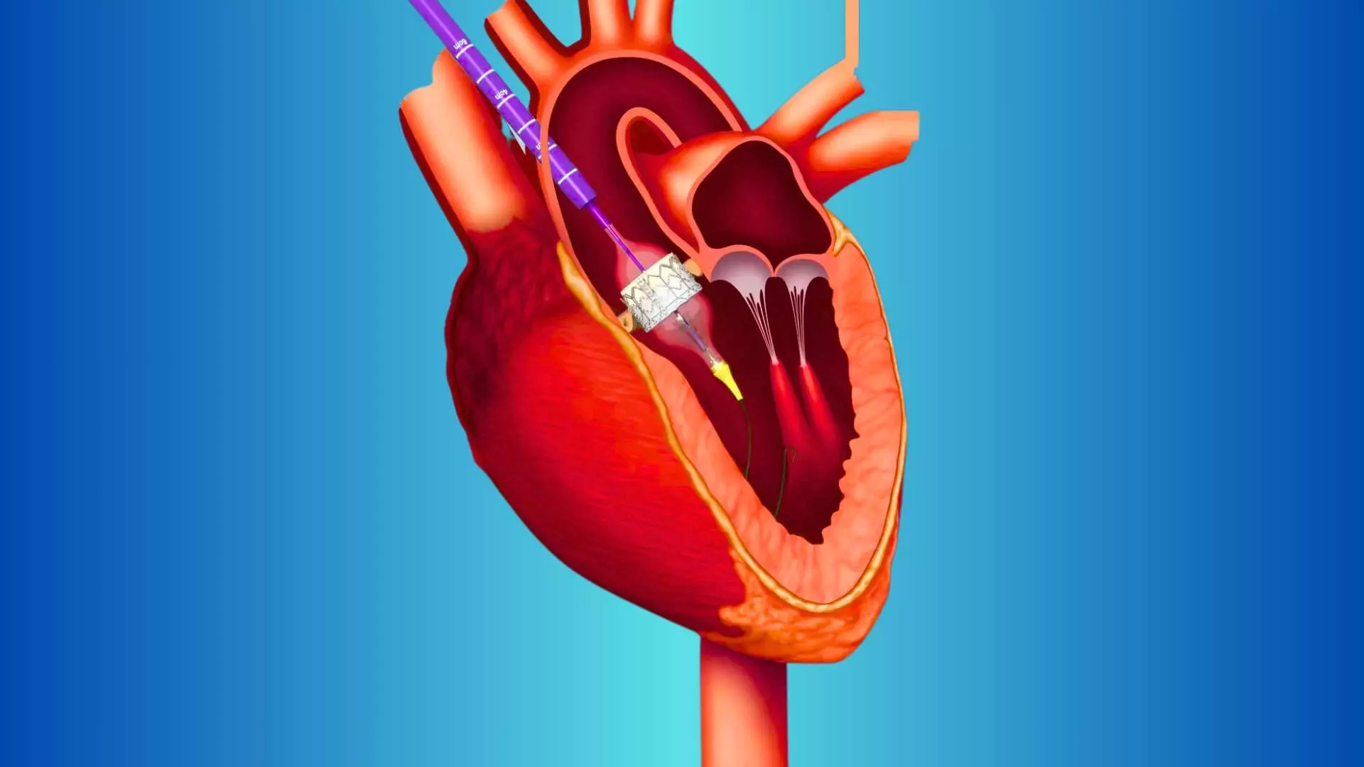 TCT 2025: Transcatheter or Surgical Aortic-Valve Replacement in Low-Risk Patients at 7 Years, PARTNER-3 Trial Findings