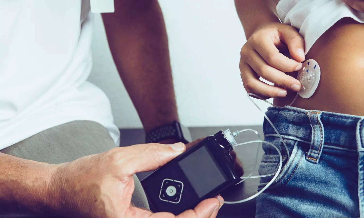 Automated Insulin Delivery Benefits Adults with Type 2 Diabetes Regardless of C-Peptide Levels: Study Finds