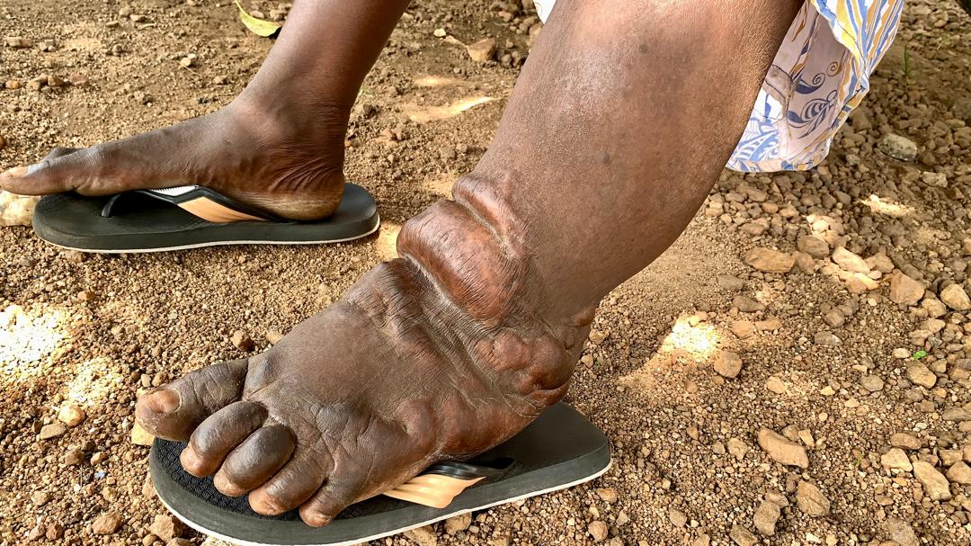 The curse that wasn’t: Unmasking the myths behind elephantiasis in Upper East region
