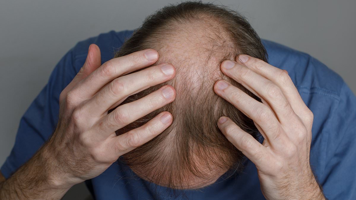 The hair loss treatment revolution: Experts reveal the scientifically proven ways to beat balding