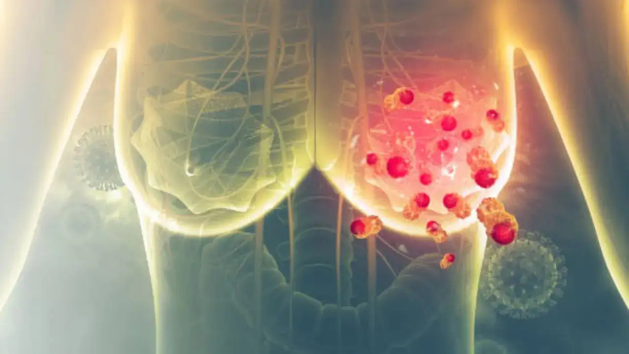 Breast Cancer Risk Isn’t Just Genetic — Lifestyle Plays a Bigger Role Than You Think