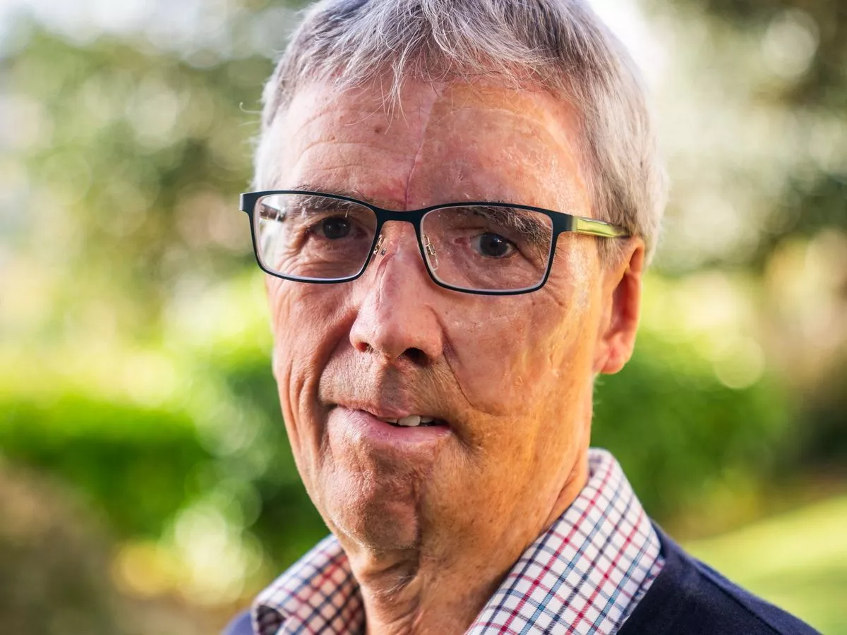 NHS gives cyclist new '3D printed face' after horror crash