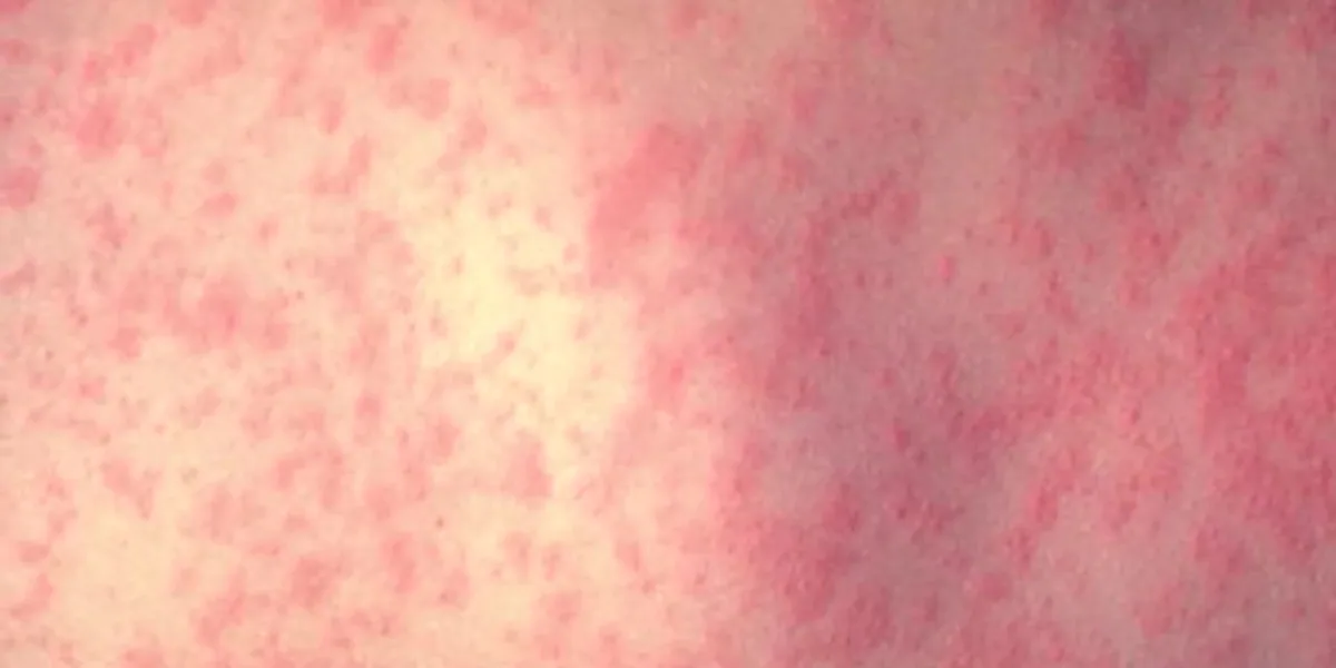 Canada is poised to lose its measles elimination status - and the US could, too