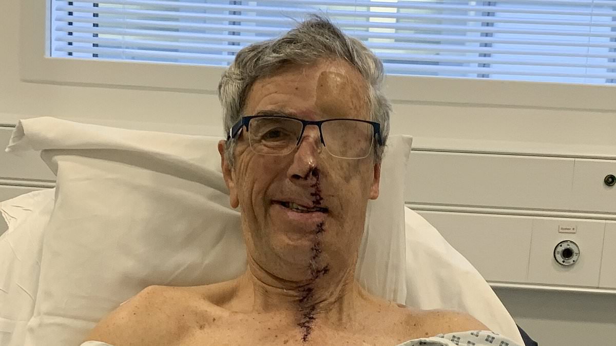 Grandfather-of-four, 75, gets '3D printed face' after drunk driver crash left him with horrific disfigurements