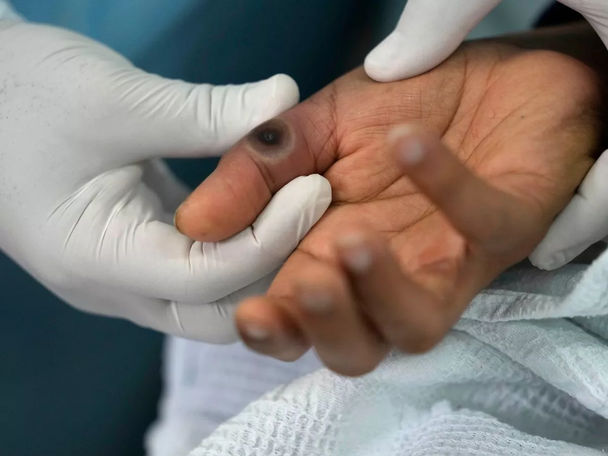 Health officials issue mpox warning as 'unpleasant and painful' disease spreads across Europe