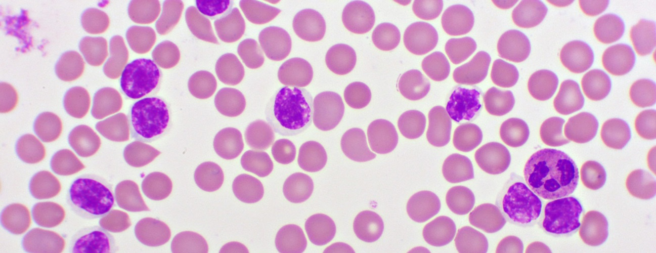 Joy Cancer Awareness Month: Expert warns parents on early signs and treatment of childhood leukaemia