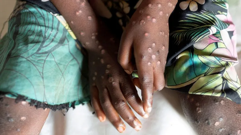 Ghana’s Mpox Cases Hit 744
