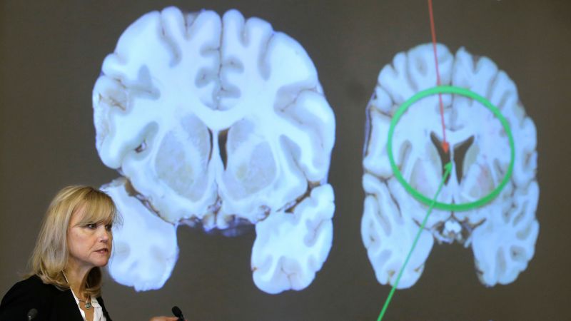 Hidden genetic damage is part of CTE, too, study finds