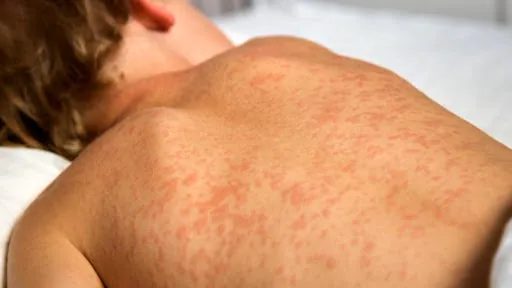 Measles outbreak expected to continue in northeast B.C., health officials say
