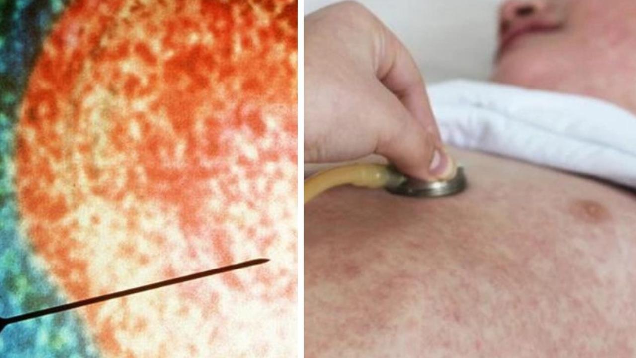 Health alert issued amid measles surge