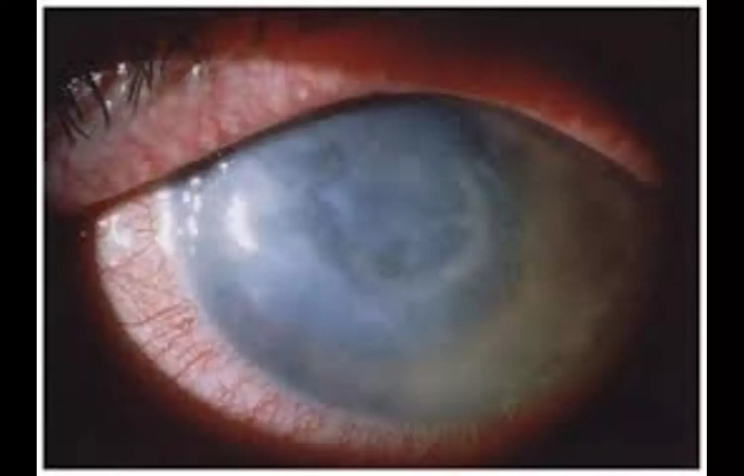 Early Detection and Treatment Key in Managing Acanthamoeba Keratitis, reveals research