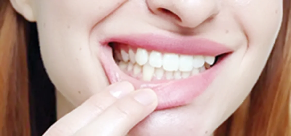 Gum disease and cavities increase stroke risk by 86% — Study