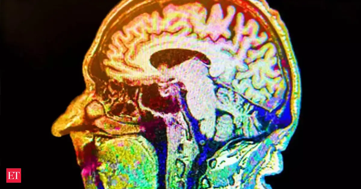 What is Chiari Malformation? The rare brain condition behind a medical mystery affecting four West Virginia sisters