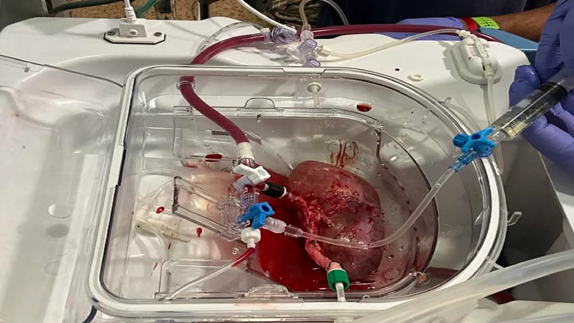 Human organoids in pig kidneys open new path for future transplants