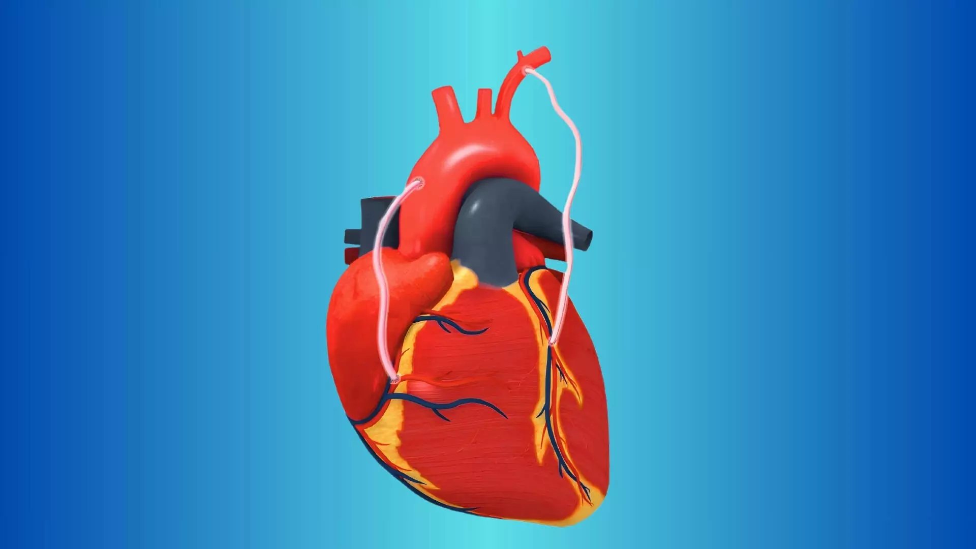 TCT 2025: iCABG Study Comparing iFR Versus Angiography Guided CABG Over 36 Months Follow-Up Period