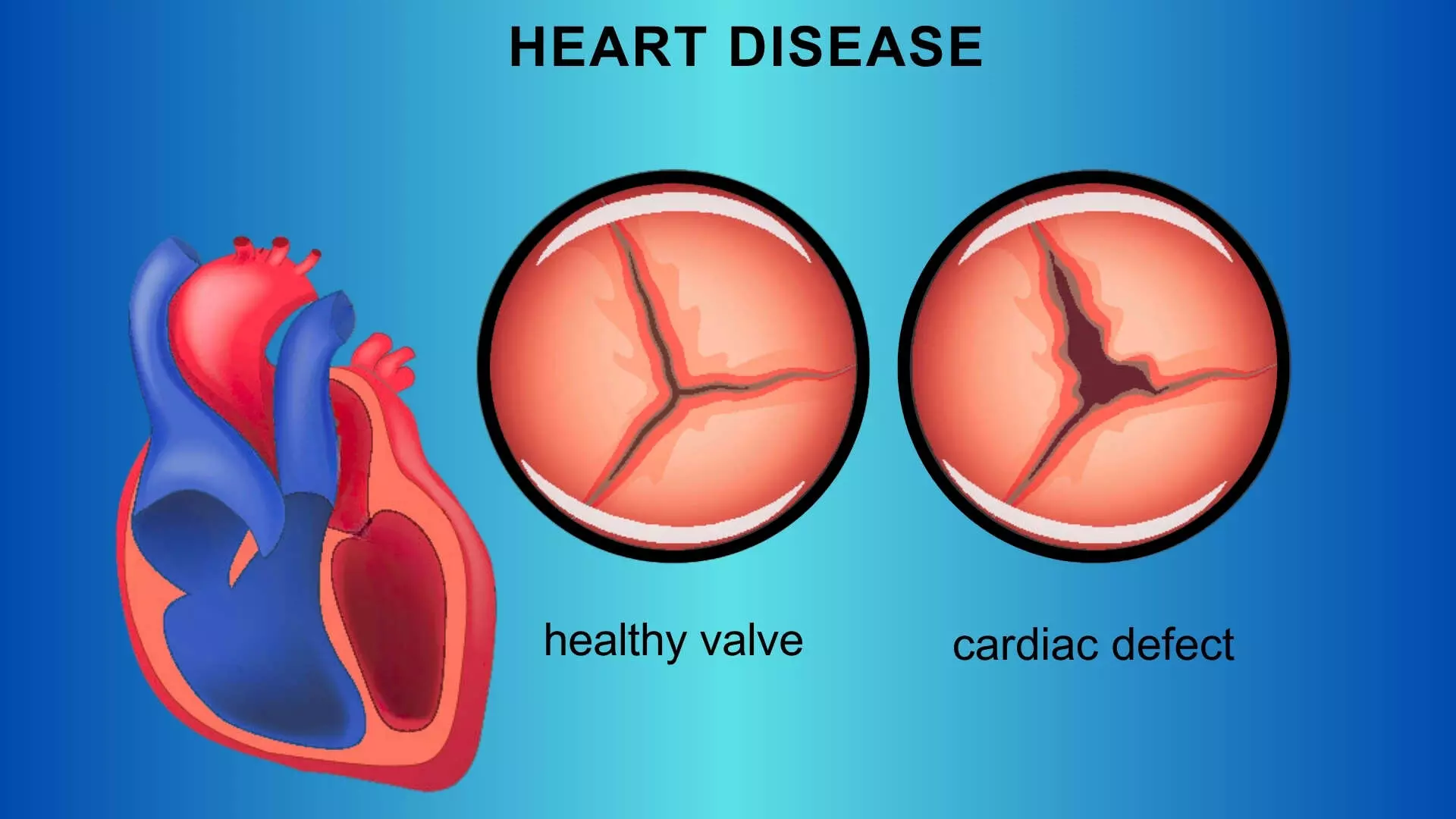 TCT 2025: PREVUE-VALVE Study Indicates Burden of Valvular Heart Disease in Adults Aged 65-85 Years
