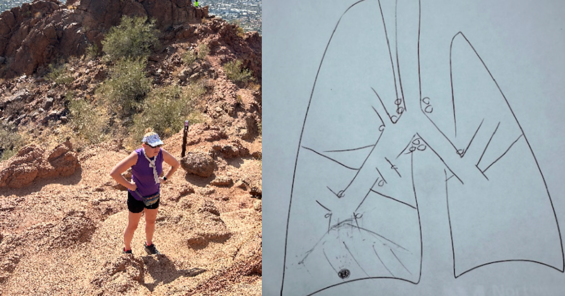 How a broken limb led to a non-smoker's lung cancer diagnosis a decade later