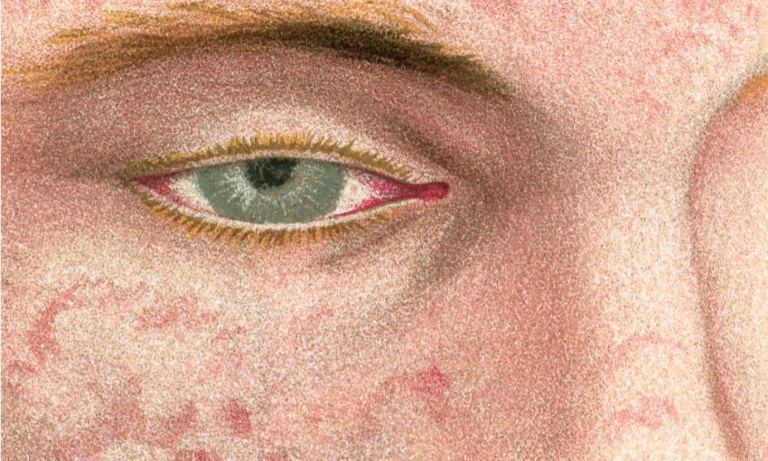 What’s it like to have adult measles? I asked my father