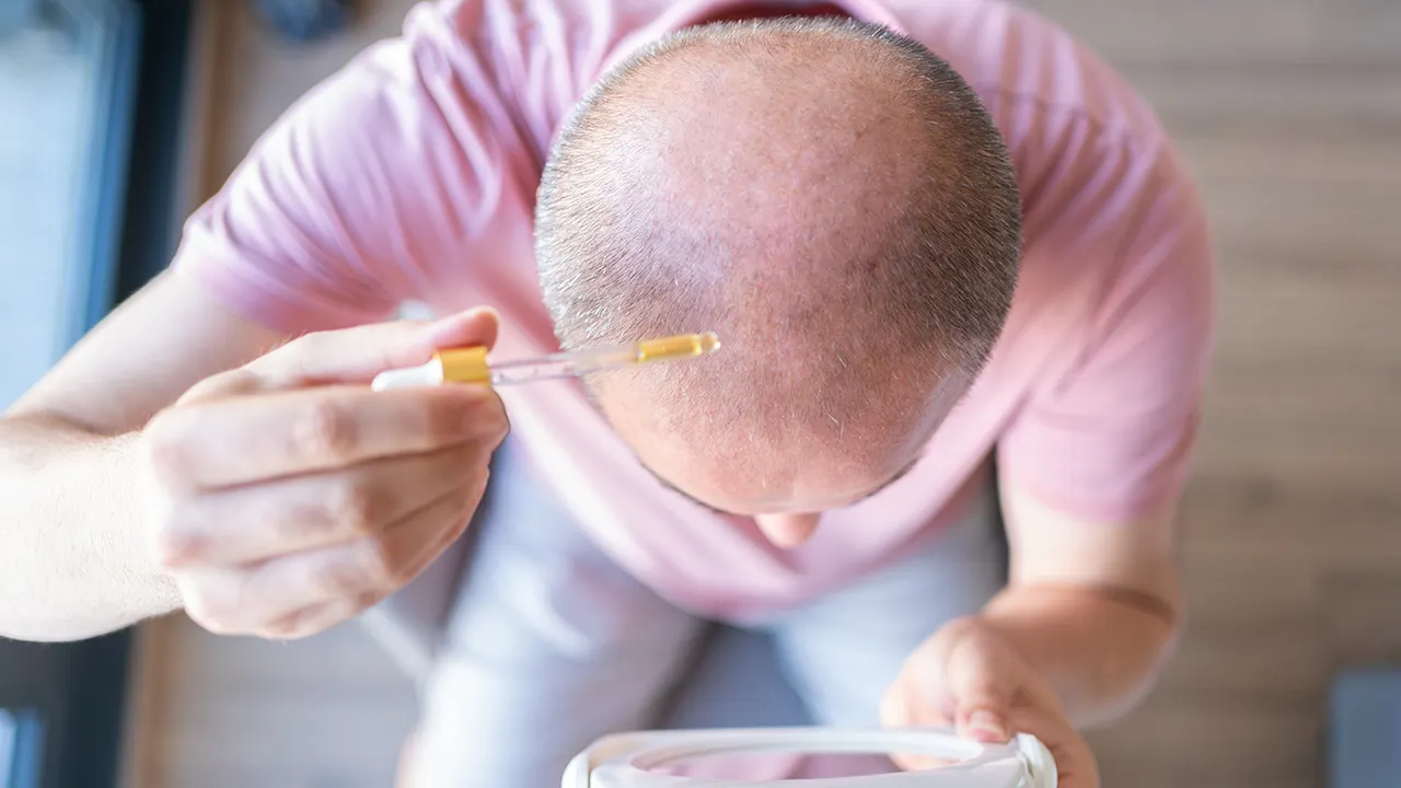 Experimental serum shows promise in reversing baldness within 20 days