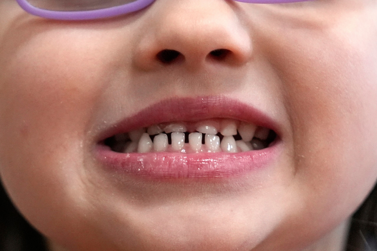 FDA limits fluoride supplements for kids, cites possible health risks