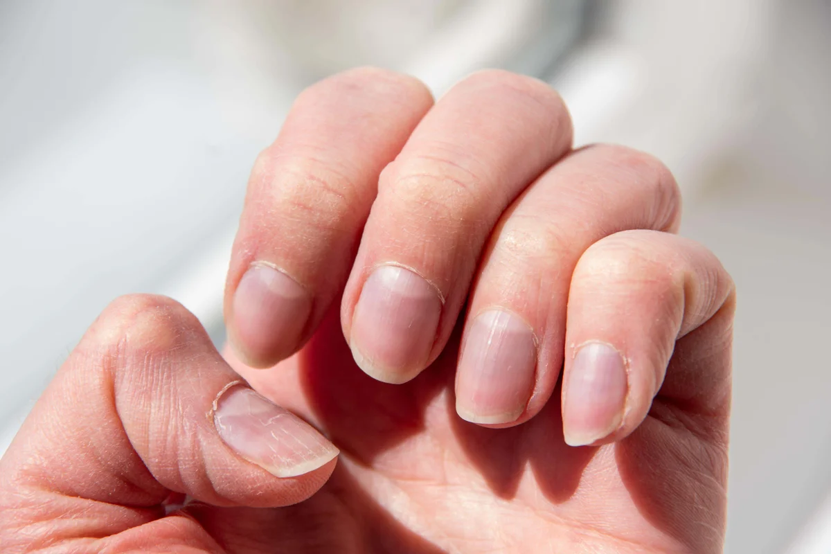 The subtle nail signs that may indicate underlying health issues
