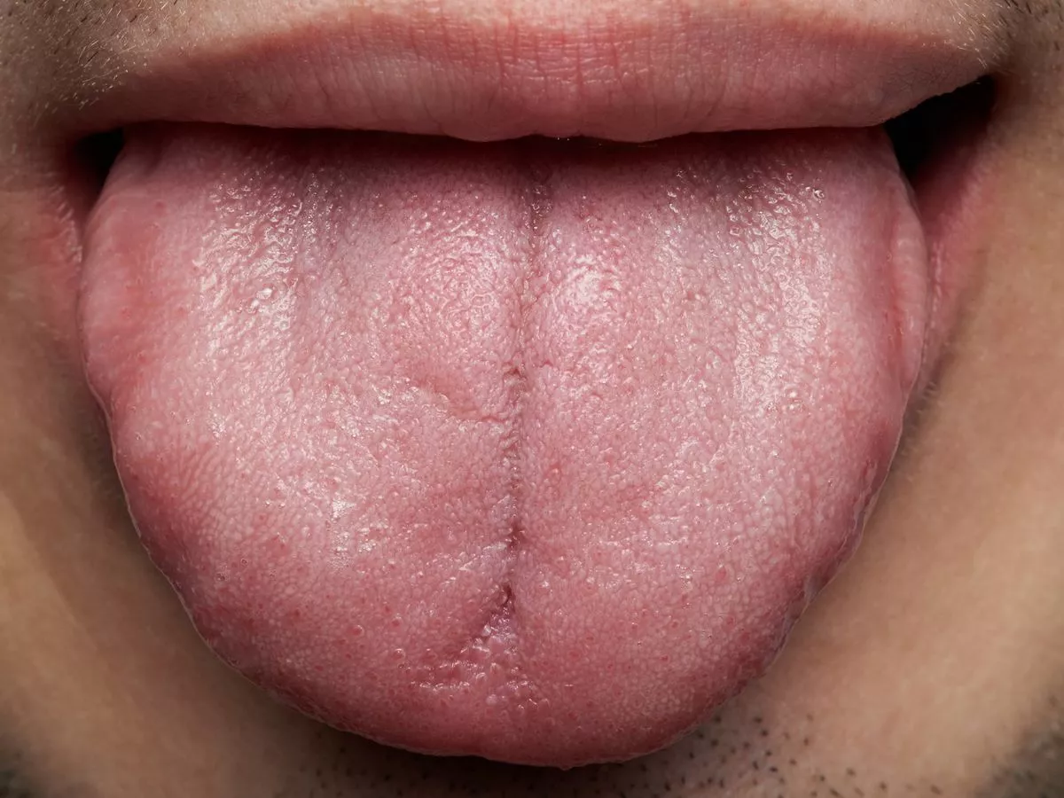 Simple tongue scan may detect early symptoms of a debilitating disease
