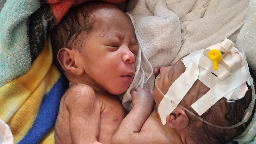 PNG conjoined twins should not be separated due to risk of death, hospital says