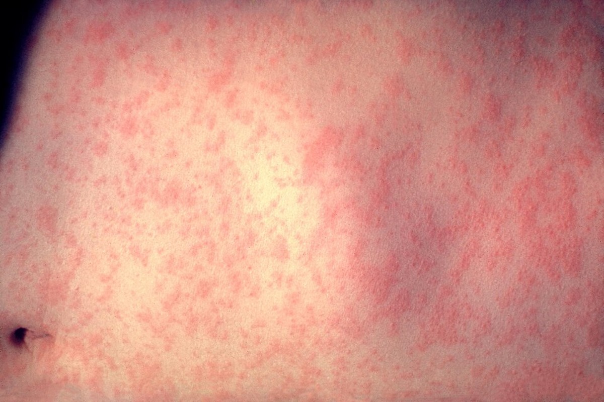 Utah Health Officials Tackle Measles Outbreak with Confirmed Case in Utah County, Suspected Case in Salt Lake County