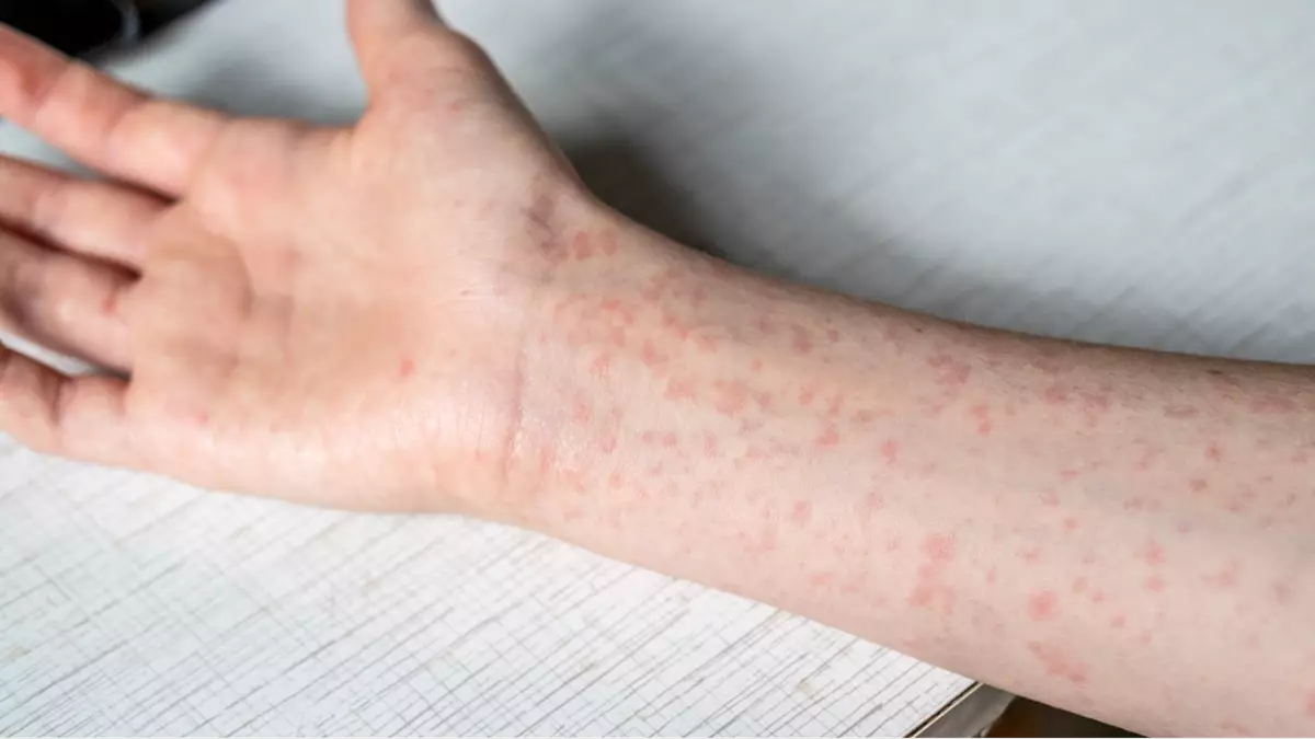 Health officials release shocking update after major measles outbreak in one US state
