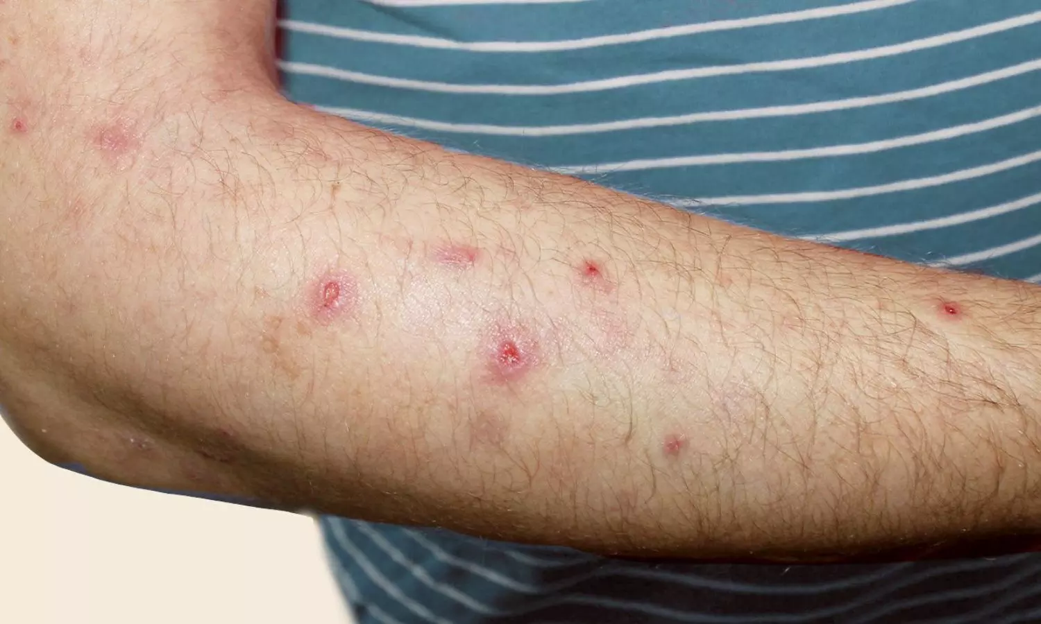 Prurigo Nodularis Greatly Increases Risk of Atopic Diseases, Especially Atopic Dermatitis, suggests study